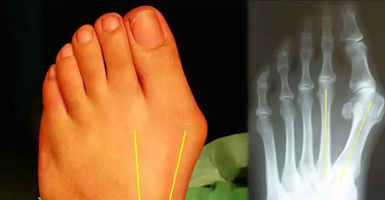 How To Get Rid of Bunions FI